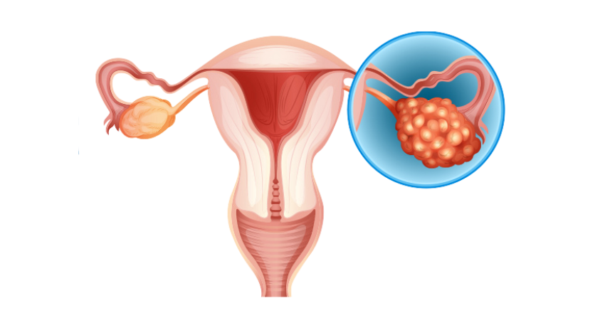 Cyst removal surgery