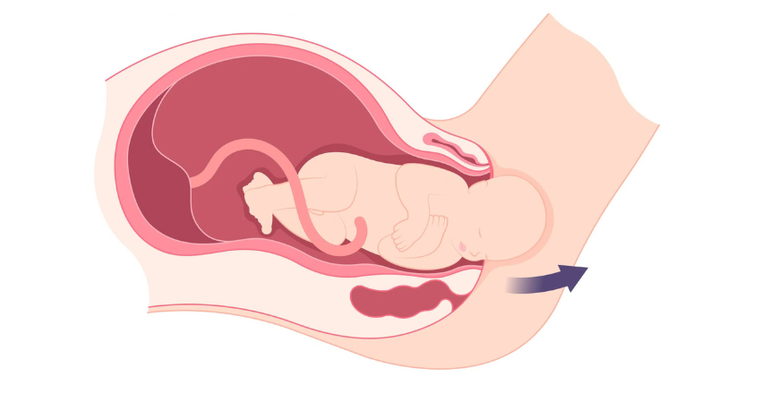 Normal delivery care